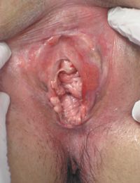 Рис. 6. Плоскоклеточная гиперплазия вульвы через 2 месяца после ФДТ