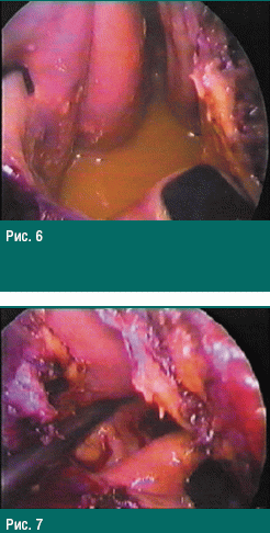 Миниинвазивные оперативные вмешательства у пациентов с болевой и кистозной формами хронического панкреатита