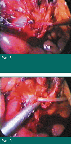 Миниинвазивные оперативные вмешательства у пациентов с болевой и кистозной формами хронического панкреатита