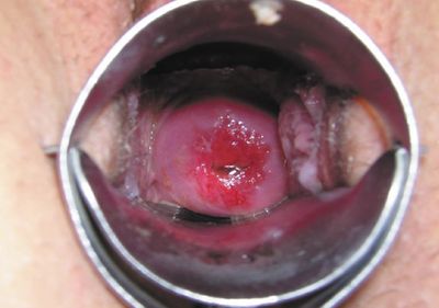 Рис. 2. Отхождение струпа на 5 день после ФДТ и начало краевой эпителизации