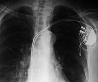 С помощью очень нехитрых средств исследователи смогли получить доступ к имплантируемому кардиостимулятору и нарушить нормальное функционирование устройства