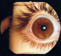 Рис. 1. Полнокровие сосудов при переутомлении глаза