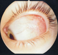 Рис. 2. Выраженная гиперемия и фолликулез (бугристость) оболочки глаза (конъюнктивы)