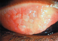 Рис. 4. Аллергический коньюнктивит, течение которого отягощено неупорядоченной работой с видеотерминалом компьютера; видна воспаленная красная конъюнктива со множеством узелковых уплотнений
