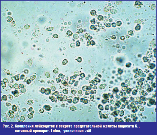 Микроскопическое исследование предстательной железы. Лейкоциты в секрете простаты микроскопия. Простатический сок микроскопия. Лецитиновые зерна в секрете простаты микроскопия. Микроскопия секрета предстательной железы.