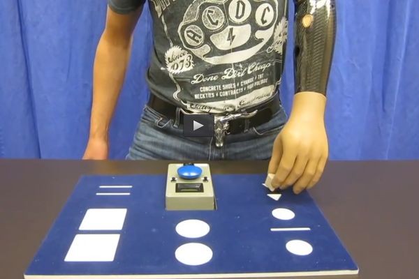 Впервые восстановлена подвижность парализованной руки путем бионической реконструкции