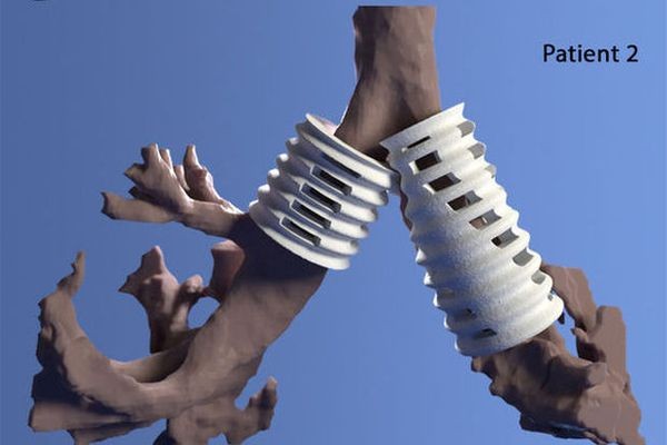 «Четырехмерная» печать спасает жизни