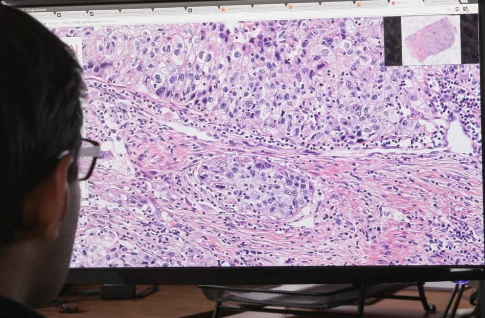 Искусственный интеллект поможет точнее диагностировать рак груди