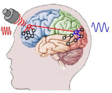 Воздействие сфокусированным ультразвуком на мозг перспективно для лечения болезни Паркинсона