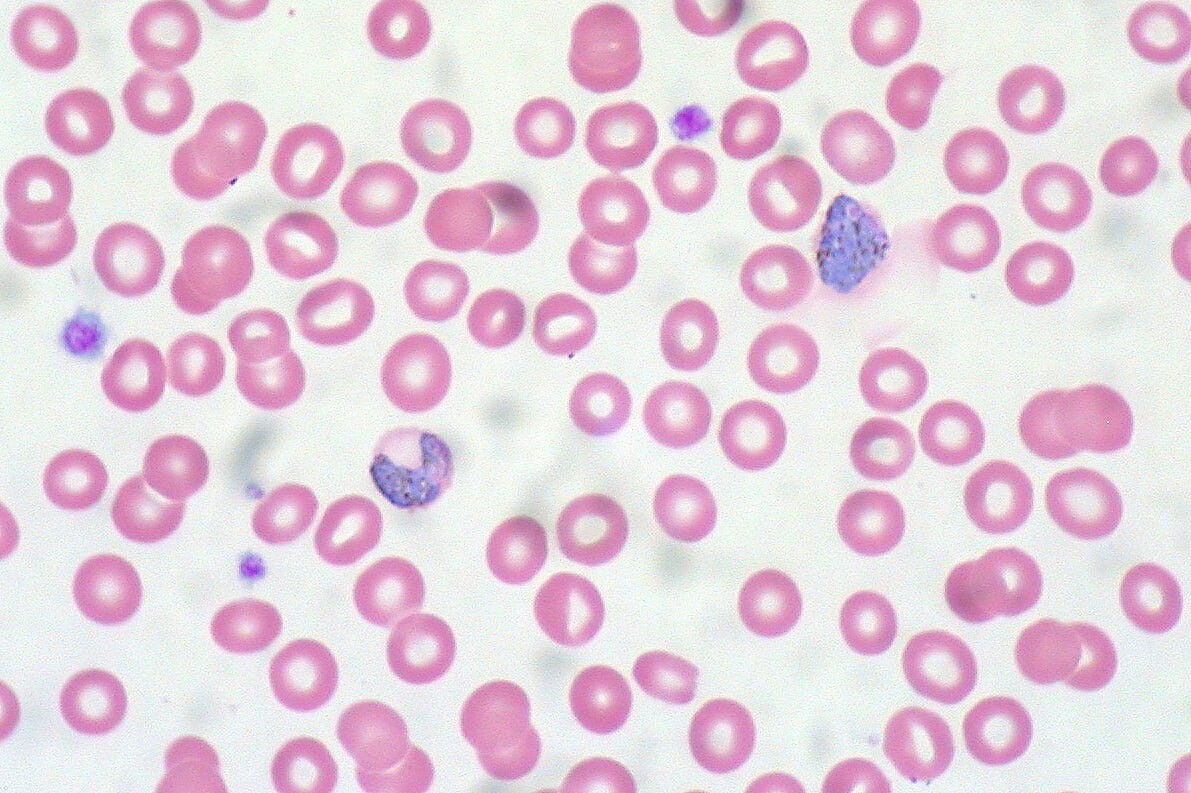 Малярия клетки. Плазмодий Вивакс. Малярия Вивакс. Малярия картина крови. Гематология микроскоп.