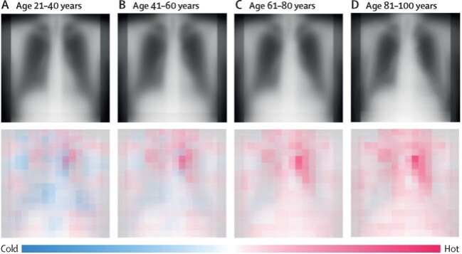 Смотрит в душу: ИИ научился определять возраст по снимкам грудной клетки