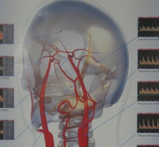 Аналитические инструменты помогут жертвам инсульта